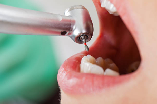 Best Emergency Dentist for Lost Fillings or Crowns in Baxter Estates, NY